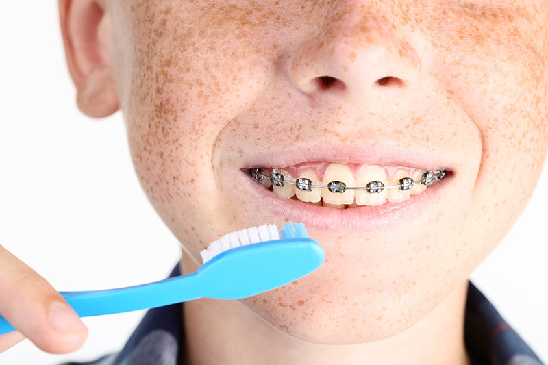 Caring for Braces