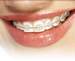 Ceramic Braces